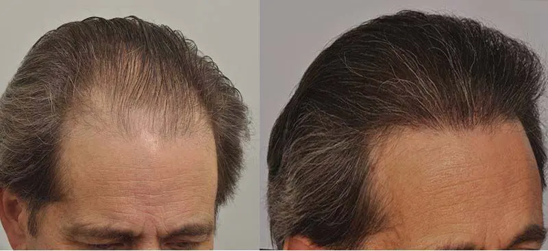 patient-ppp-before-after-right-side (1).webp