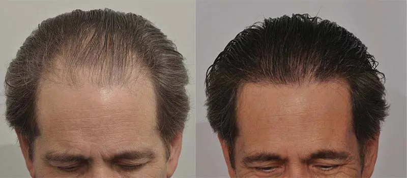 patient-ppp-before-after-front-hair-wet (1).webp