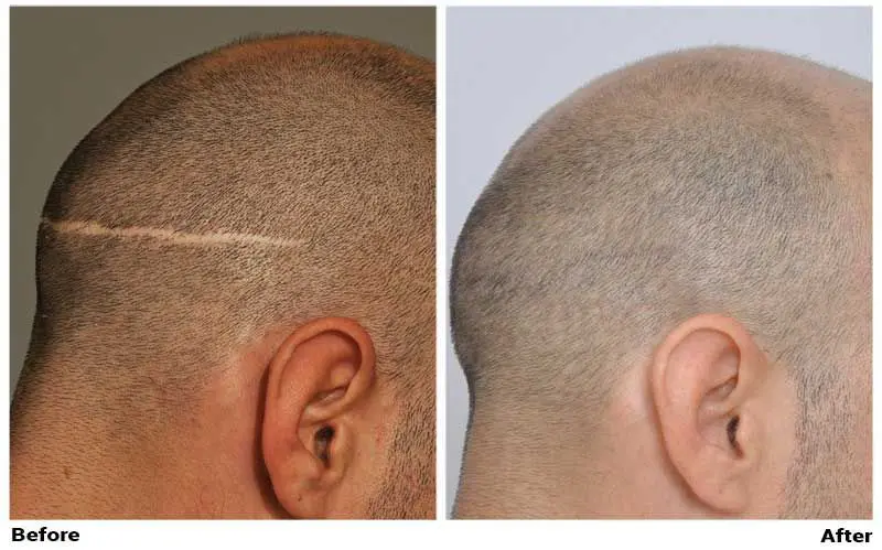 before-after-fue-scar-right-side.webp