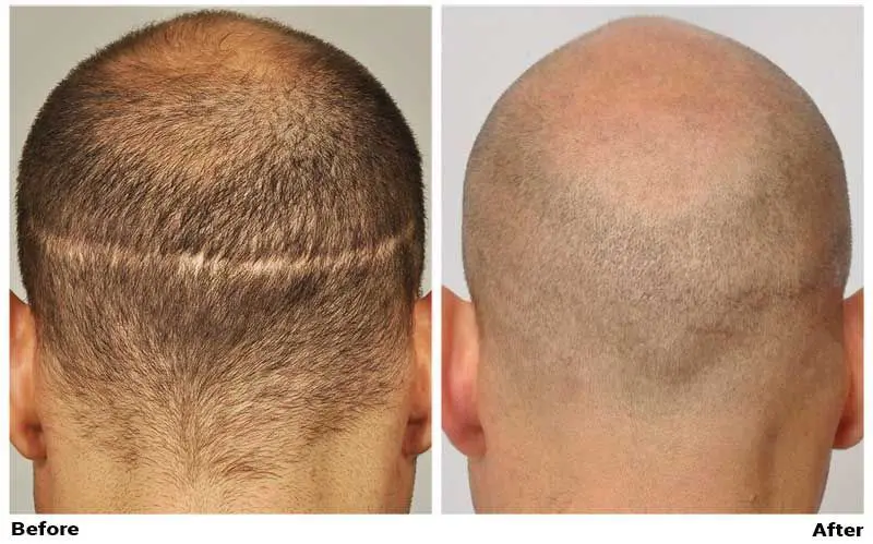 before-after-fue-scar-back2 (1).webp