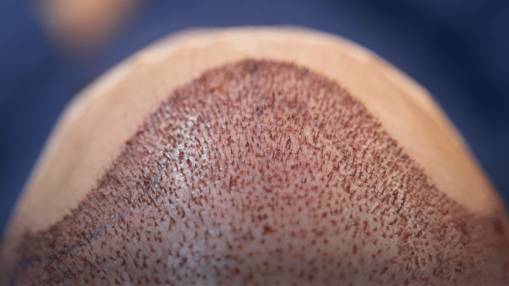 all-inclusive-hair-transplant