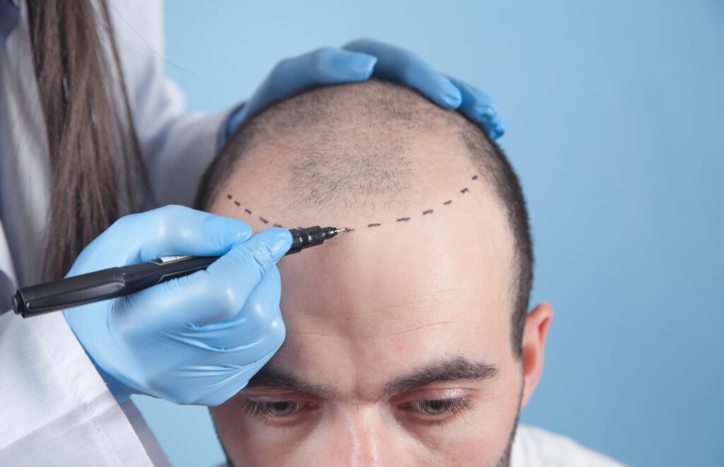 XP Hospital, top hair restoration clinic in Turkey specializing in Choi Pen DHI hair transplants.