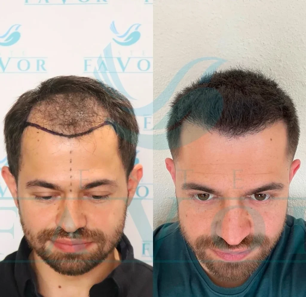 Σύγκριση πριν και μετά που δείχνει πυκνή και ομοιόμορφη ανάπτυξη μαλλιών μετά από μεταμόσχευση μαλλιών DHI που πραγματοποιήθηκε από τη Δρ. Zeycan Gürcan Çıkış στην Κλινική Μεταμόσχευσης Μαλλιών Este Favor.