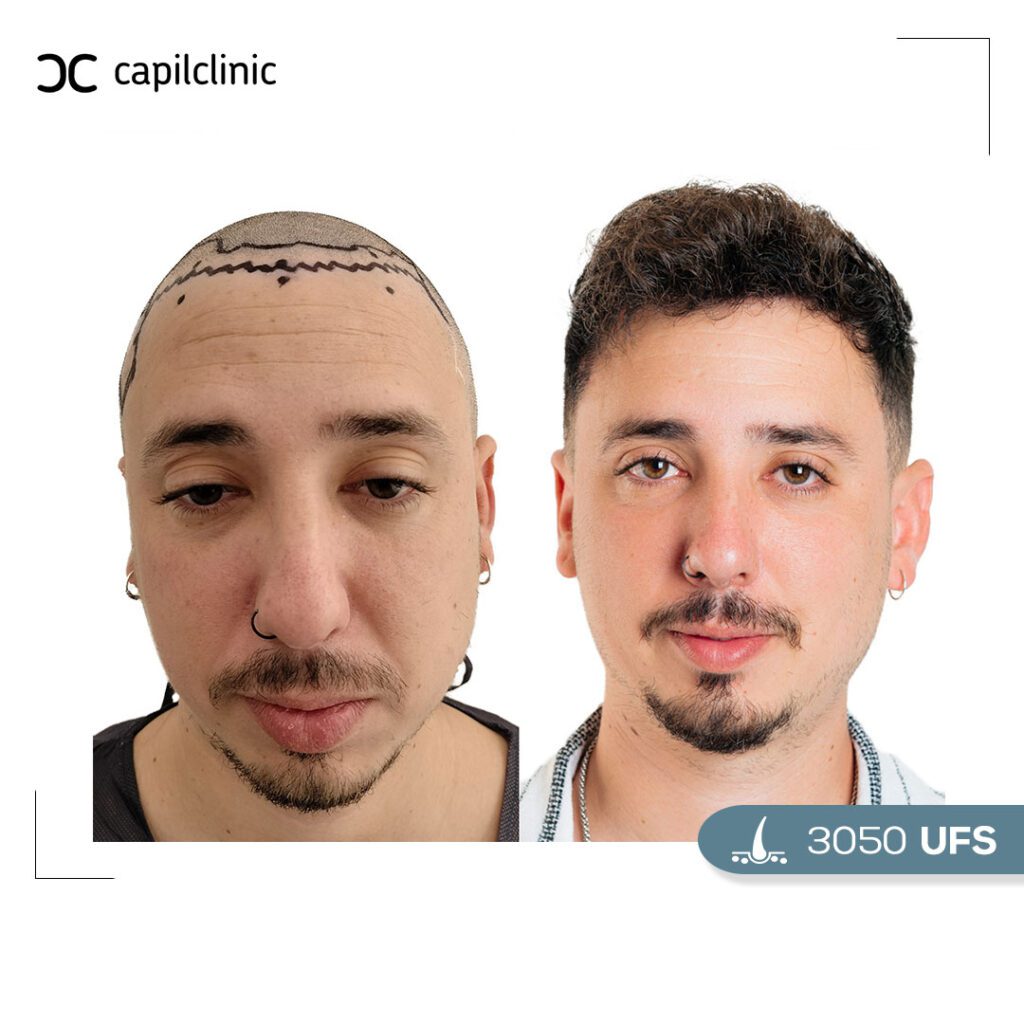 capilclinic-before-after