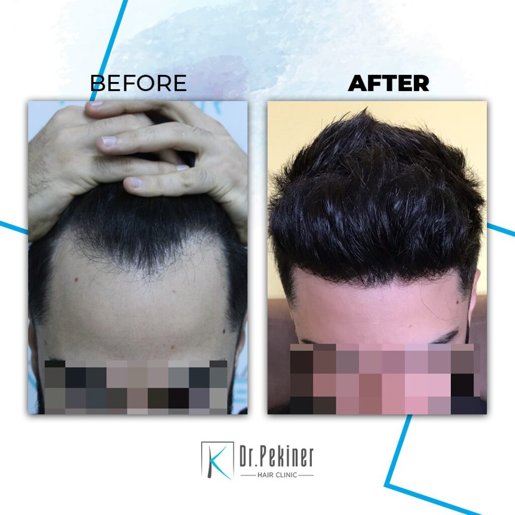 Αποτελέσματα Πριν και Μετά τη Μεταμόσχευση Μαλλιών από τον Δρ. Kaan Pekiner 2 Μεταμόσχευση Μαλλιών Δρ. Kaan Pekiner Πριν και Μετά 2
