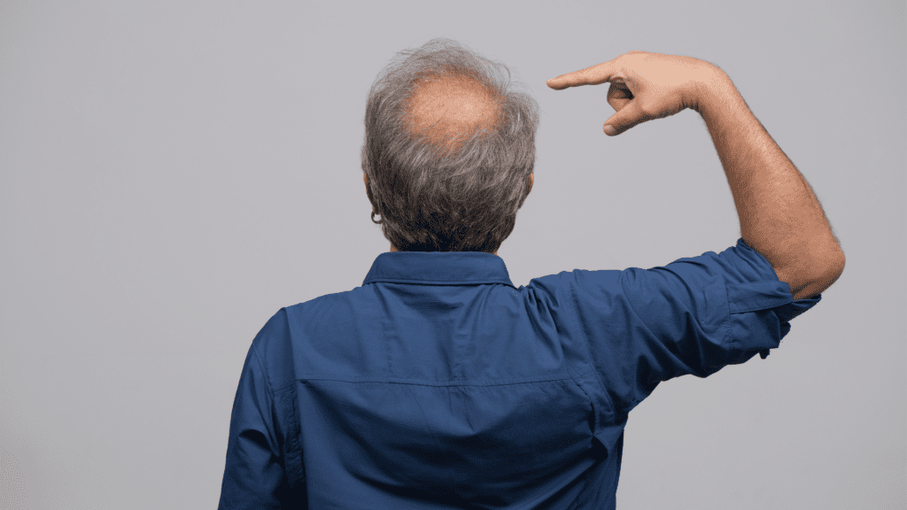 Το MicroRNA Θα Μπορούσε να Θεραπεύσει τη Φαλάκρα – Προωθώντας την Ανάπτυξη Μαλλιών σε Γηρασμένους Θύλακες