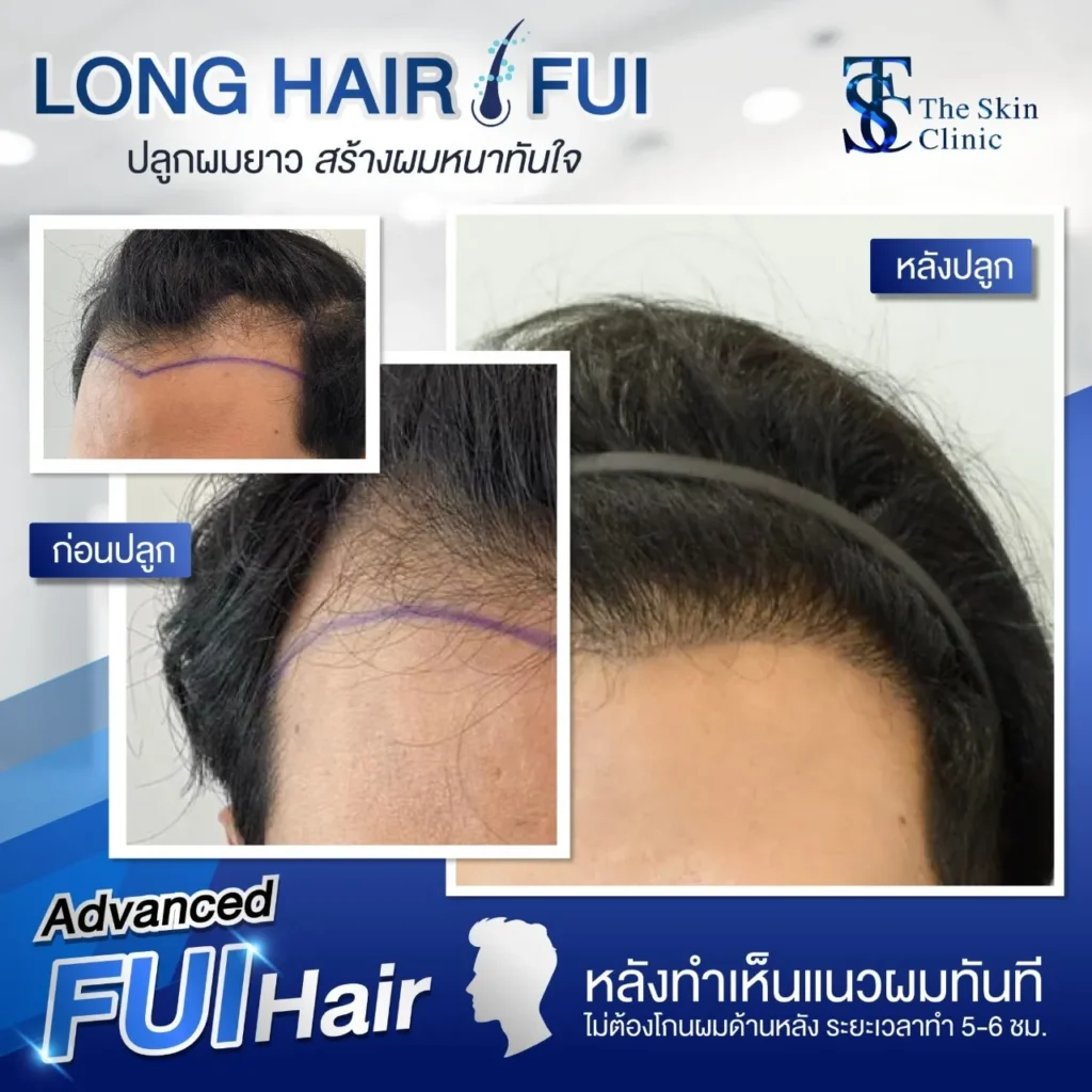 Μεταμόσχευση Μαλλιών Long FUE – Αποτέλεσμα 5 Μεταμόρφωση Αποτέλεσμα Long FUE 5 – Μεταμόρφωση Μεταμόσχευσης Μαλλιών