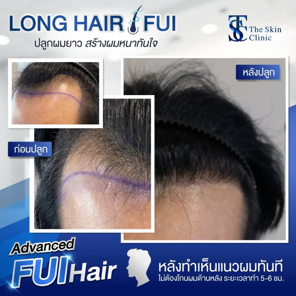 Αποτέλεσμα Long FUE 3 – Μεταμόρφωση Μεταμόσχευσης Μαλλιών