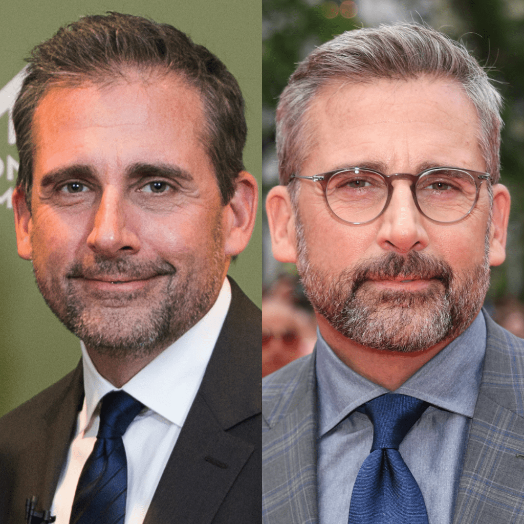 Steve-Carell-μεταμοσχευση-μαλλιων