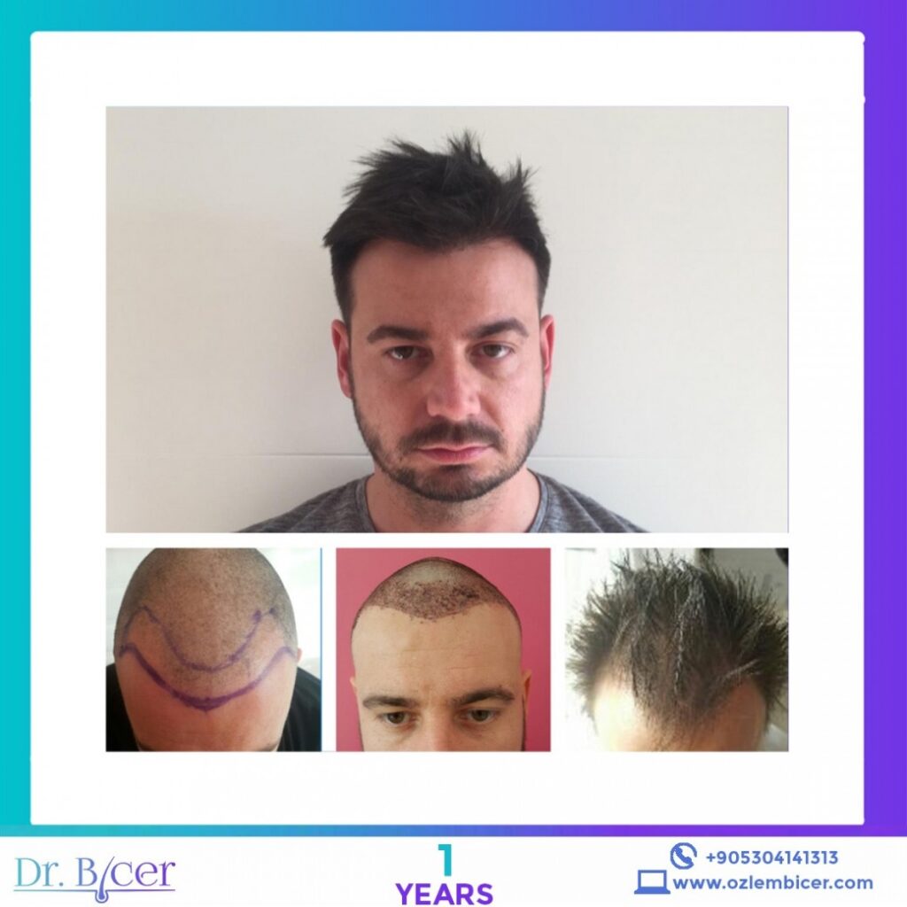 Δρ. Bicer Κωνσταντινούπολη Αποτελέσματα Μεταμόσχευσης Μαλλιών – Πριν και Μετά