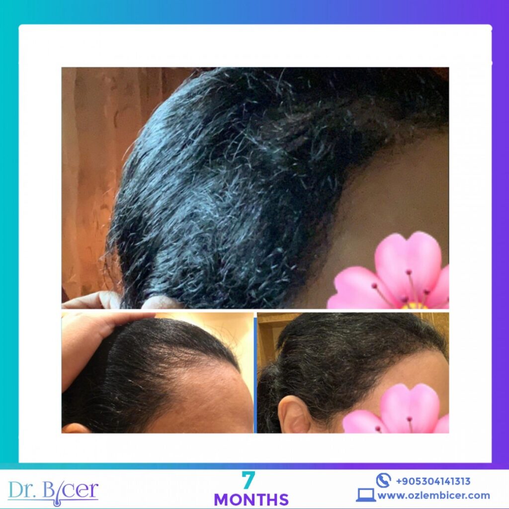 Δρ. Bicer Κωνσταντινούπολη – Μεταμόσχευση Μαλλιών Πριν και Μετά