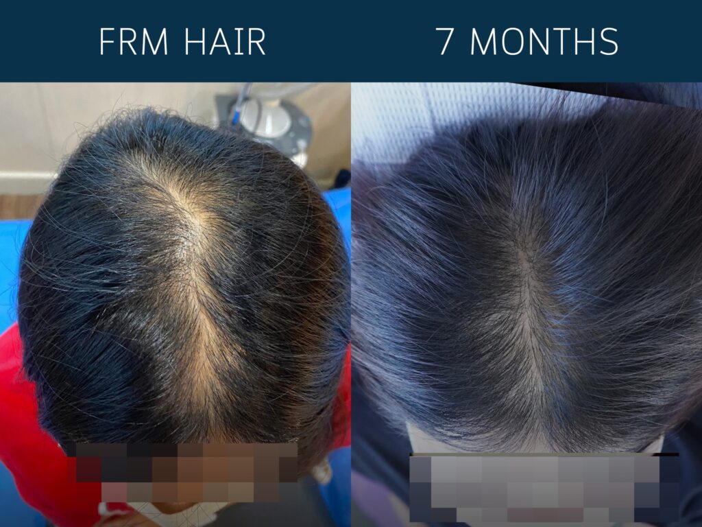 Μεταμόσχευση Μαλλιών FRM Πριν και Μετά – Φυσική Αποκατάσταση Μαλλιών FRM Μαλλιά Πριν και Μετά – Αποτελέσματα Αποκατάστασης Μαλλιών