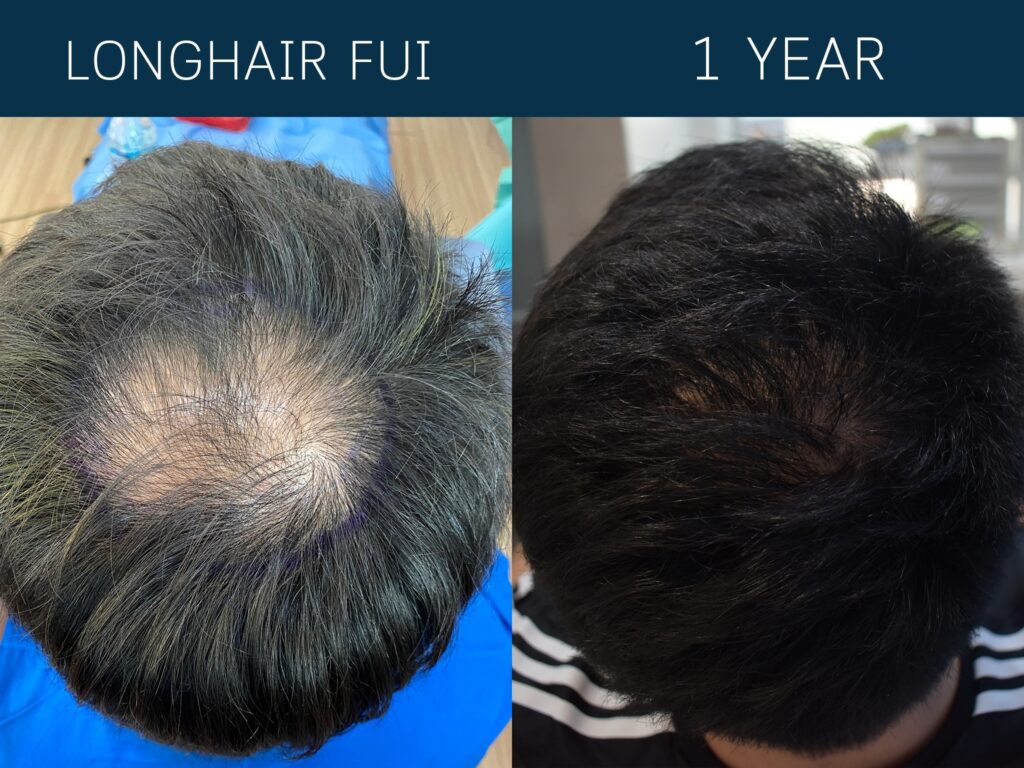 Long FUE Μπανγκόκ – Τεχνική Μεταμόσχευσης Μαλλιών Χωρίς Ξύρισμα Long FUE Μπανγκόκ – Μεταμόσχευση Μαλλιών Χωρίς Ξύρισμα