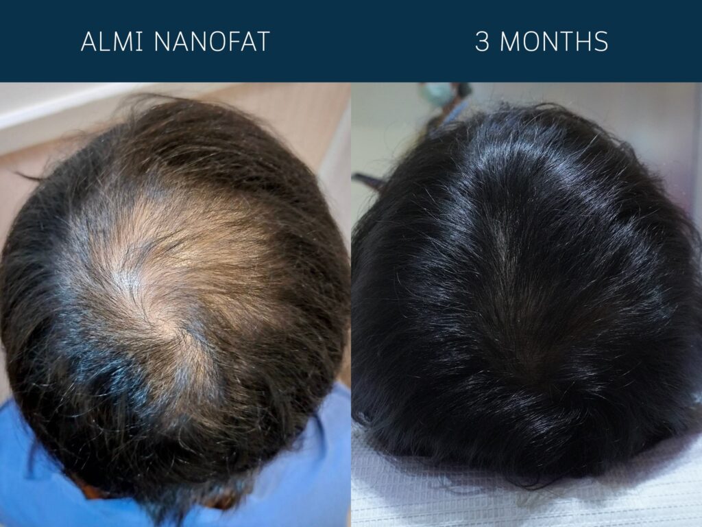 ALMI Nanofat Πριν και Μετά – Φυσική Αναζωογόνηση Δέρματος ALMI Nanofat Πριν και Μετά – Αποτελέσματα Αναζωογόνησης Δέρματος