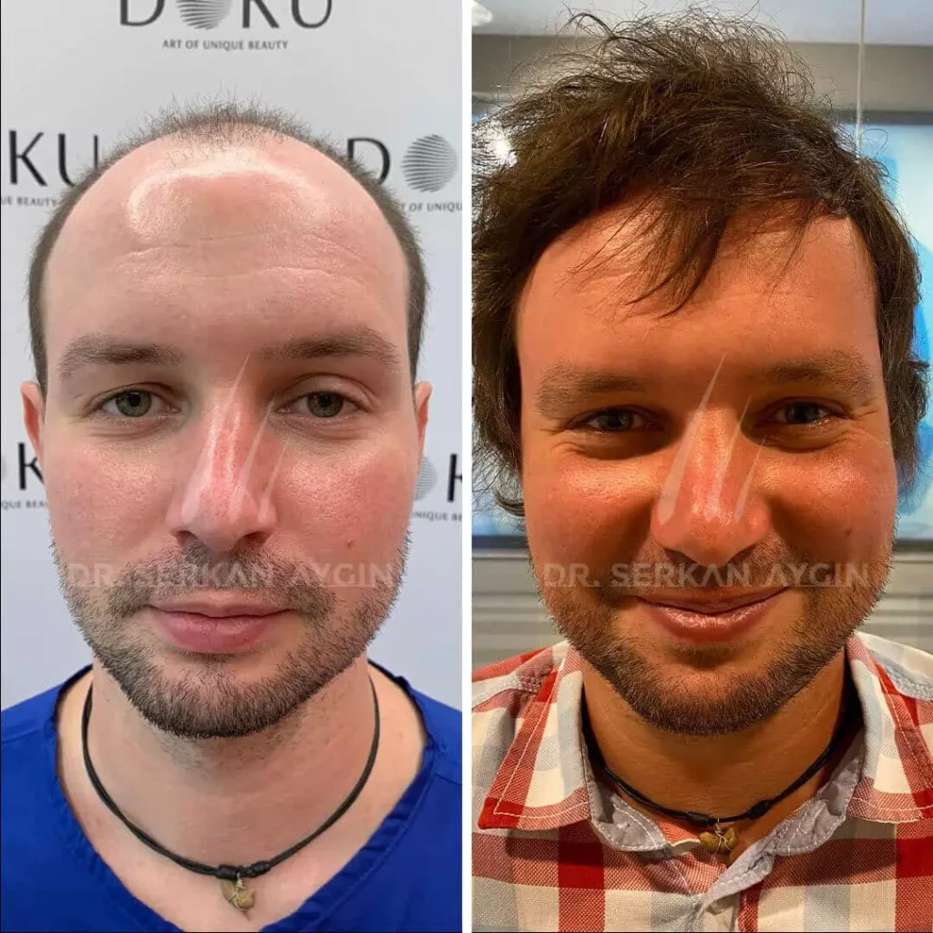 drserkanaygin-πριν-μετά