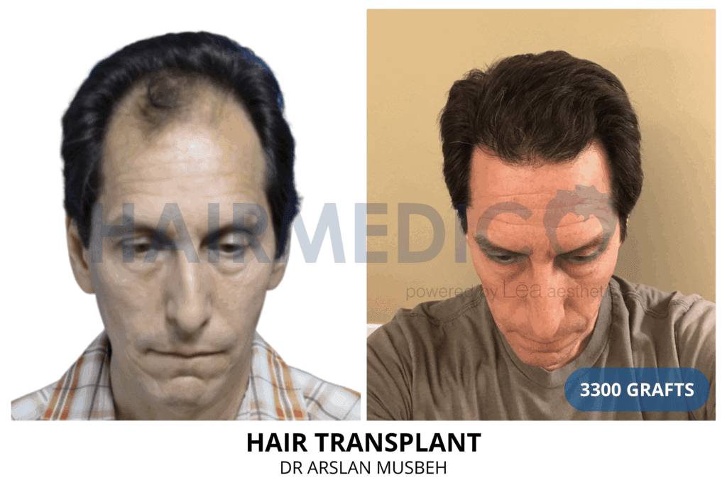 Αποτελέσματα πριν και μετά τη μεταμόσχευση μαλλιών από την κλινική Hairmedico