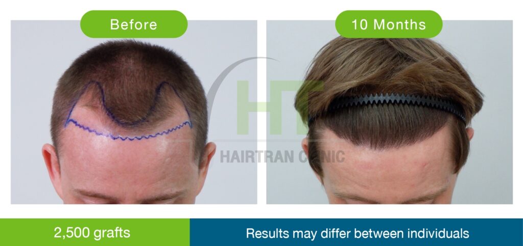 κλινική-hairtran-πριν-μετά