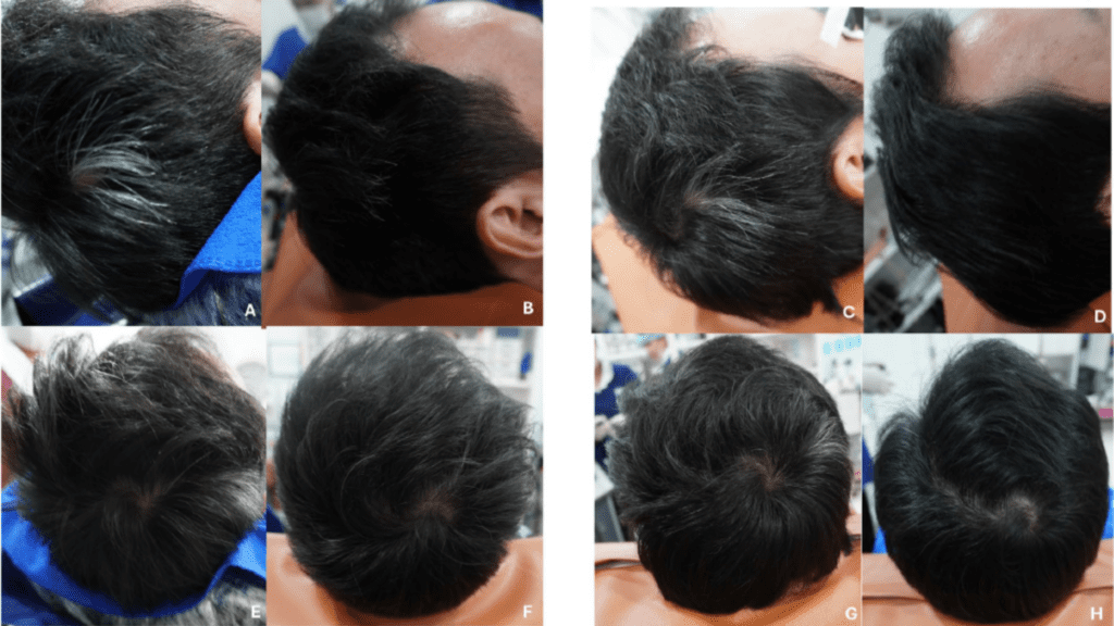 Hair Repigmentation Before and After Treatment – Exosomes + Laser Therapy