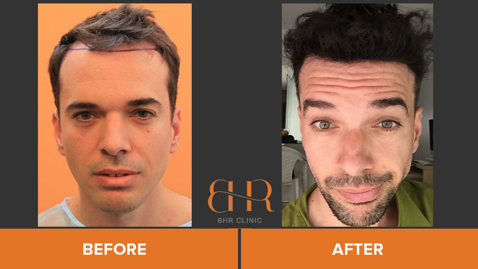 bisanga-before-after