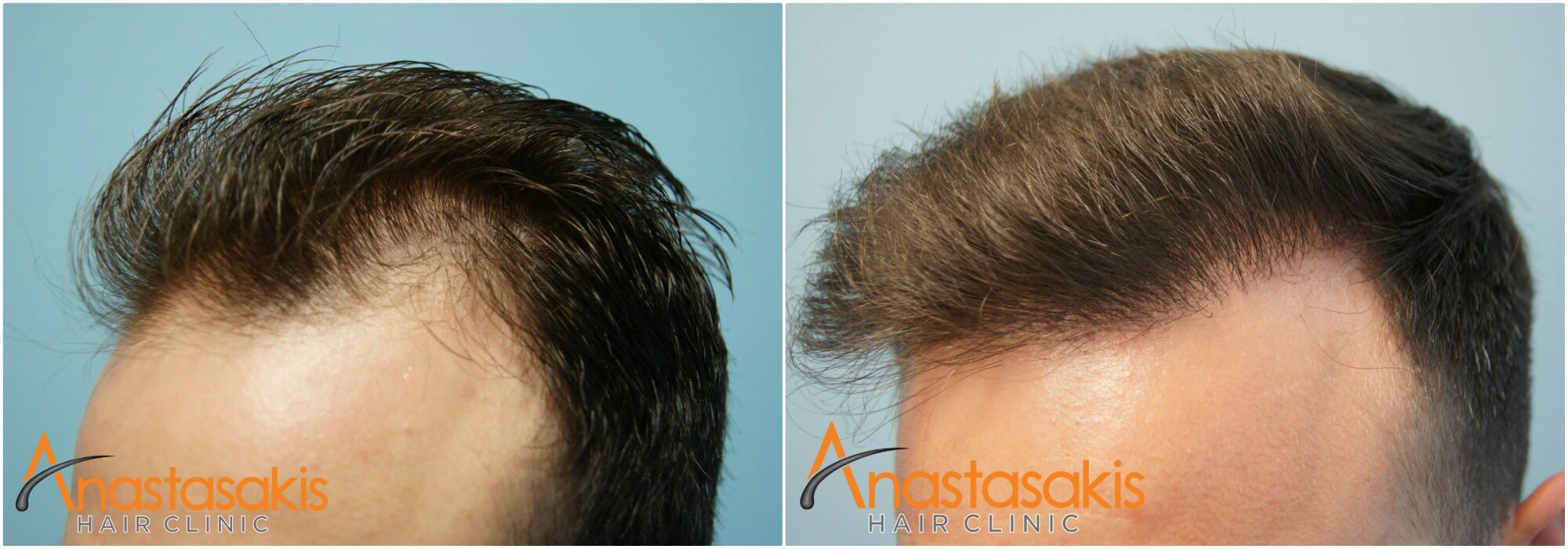 anastasakis hair clinic