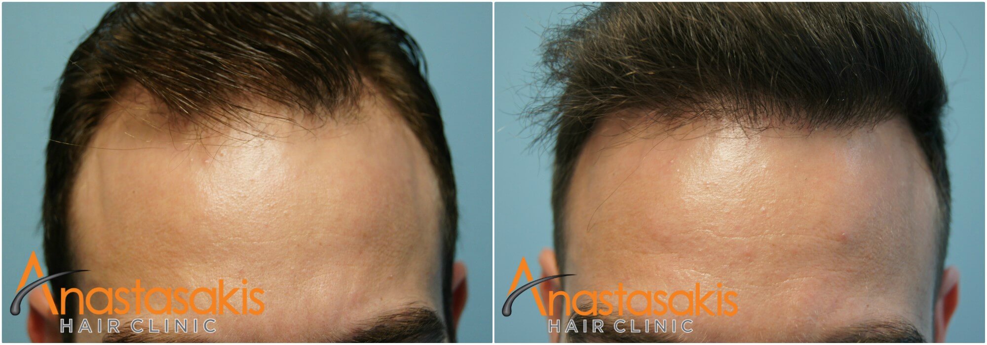 Anastassakis-hair-clinic-before-after