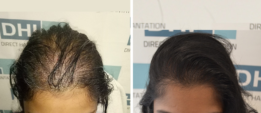 DHI India Before and After Hair Transplant Results