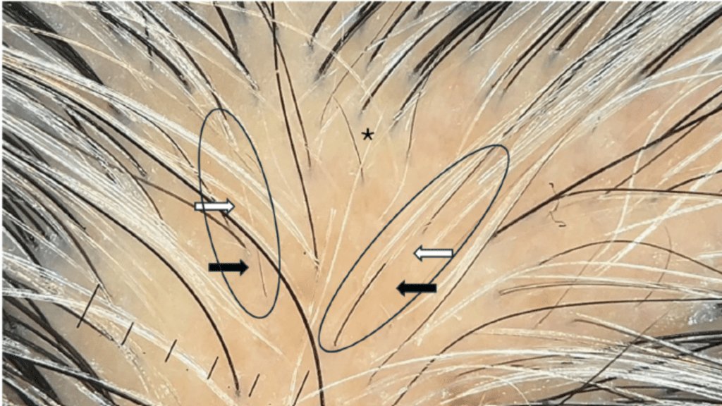 Hair Repigmentation Before and After Treatment – Exosomes + Laser Therapy