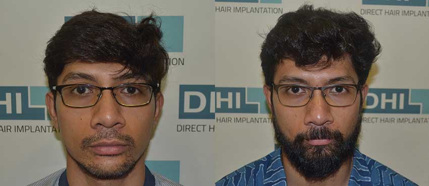DHI India Before and After Hair Transplant 1