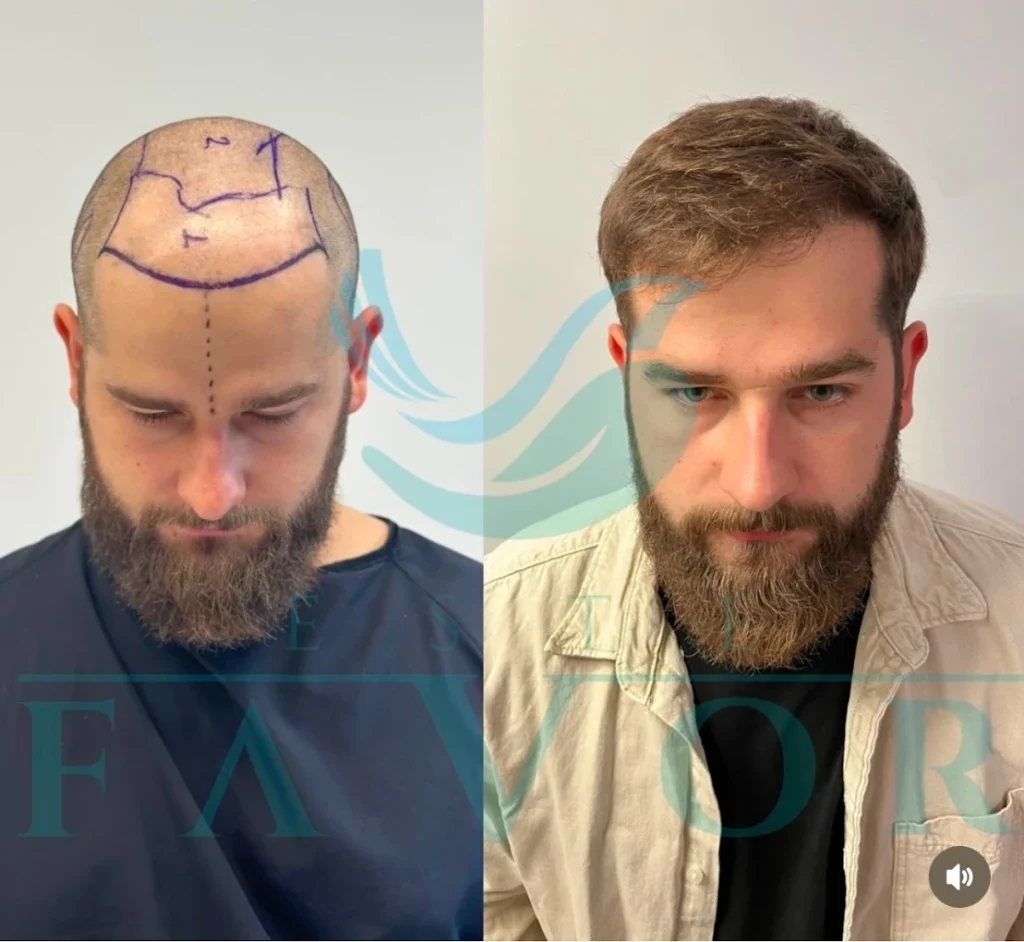 Close-up before and after photo showing restored hairline using Sapphire FUE technique performed by Dr. Zeycan Gürcan Çıkış at Este Favor Hair Transplant Clinic in Istanbul.