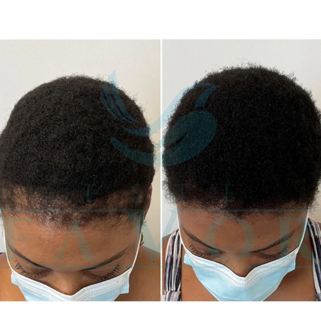 Σύγκριση πριν και μετά μιας περίπτωσης μεταμόσχευσης μαλλιών Afro στην Κλινική Μεταμόσχευσης Μαλλιών Este Favor στην Κωνσταντινούπολη, όπου η Δρ. Zeycan Gürcan Çıkış πέτυχε πυκνές, φυσικές μπούκλες με ακριβή εμφύτευση και γρήγορη ανάρρωση.