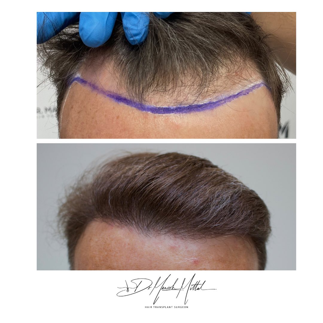 mittal-before-after