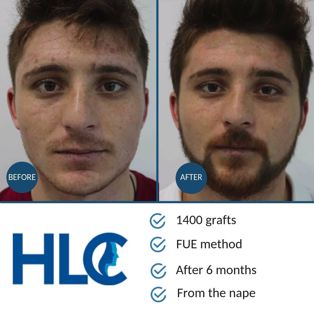 HLC-before-after