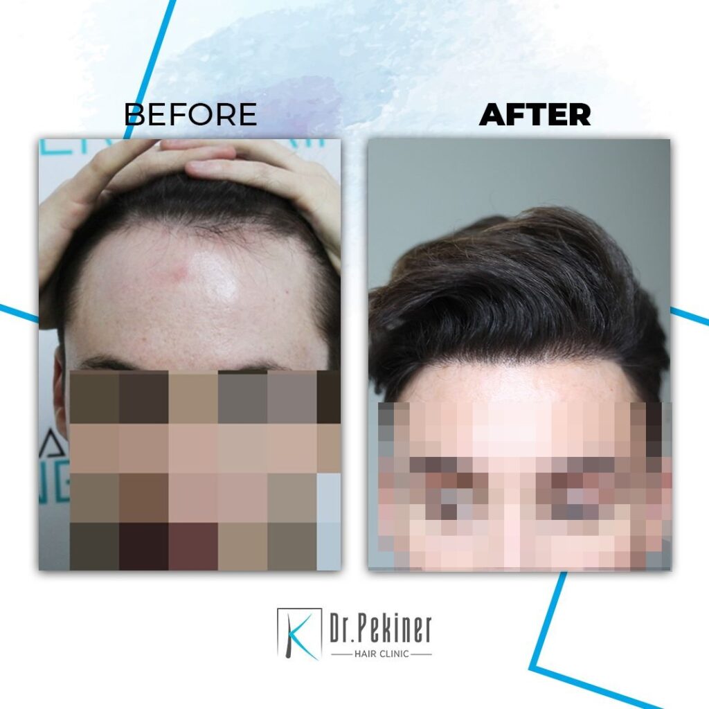 Dr. Kaan Pekiner : Top Hair Loss Clinic