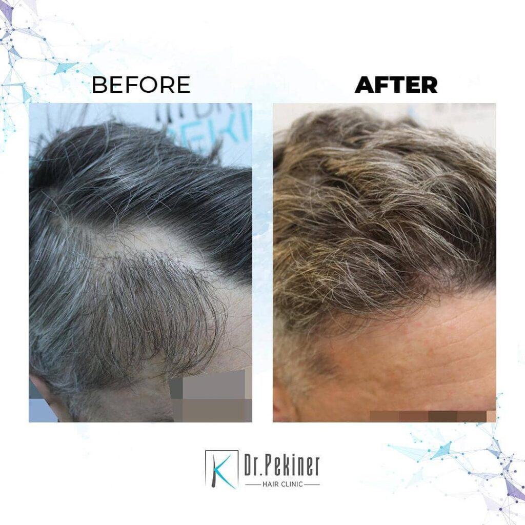 Dr. Kaan Pekiner Hair Transplant Before and After 3