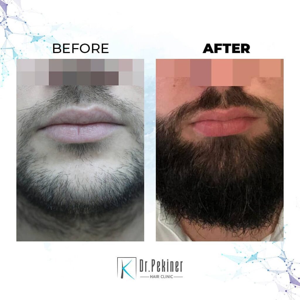 Beard Transplant by Dr. Kaan Pekiner – Natural Results