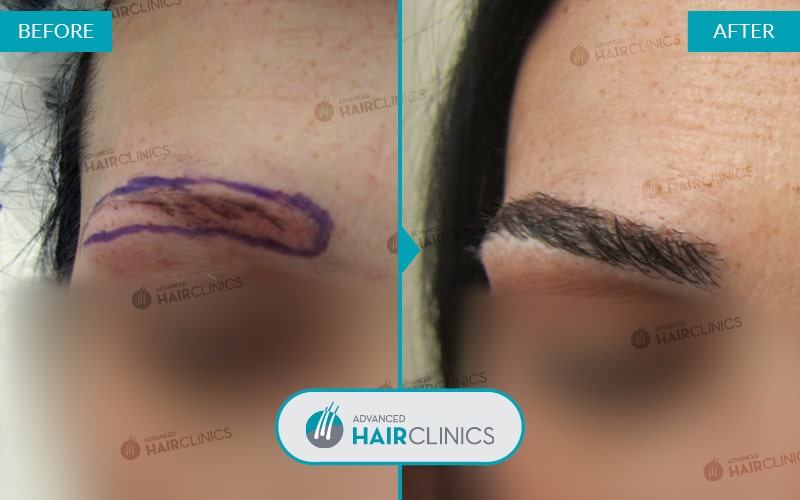 Αποτελέσματα Μεταμόσχευσης Μαλλιών Advanced Hair Clinics – Φρύδια