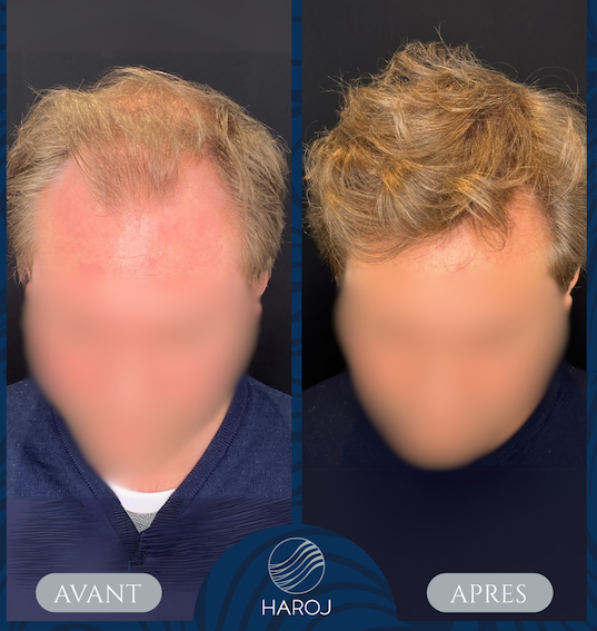 Before and after frontal hairline restoration using FUE hair transplant at Haroj Clinic in Mulhouse, France.
