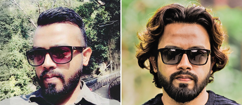 DHI India Before and After Hair Transplant Results 4