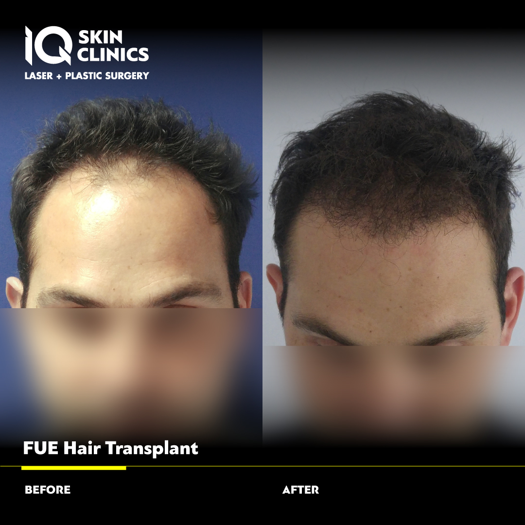 before-after-iq-skin-clinic