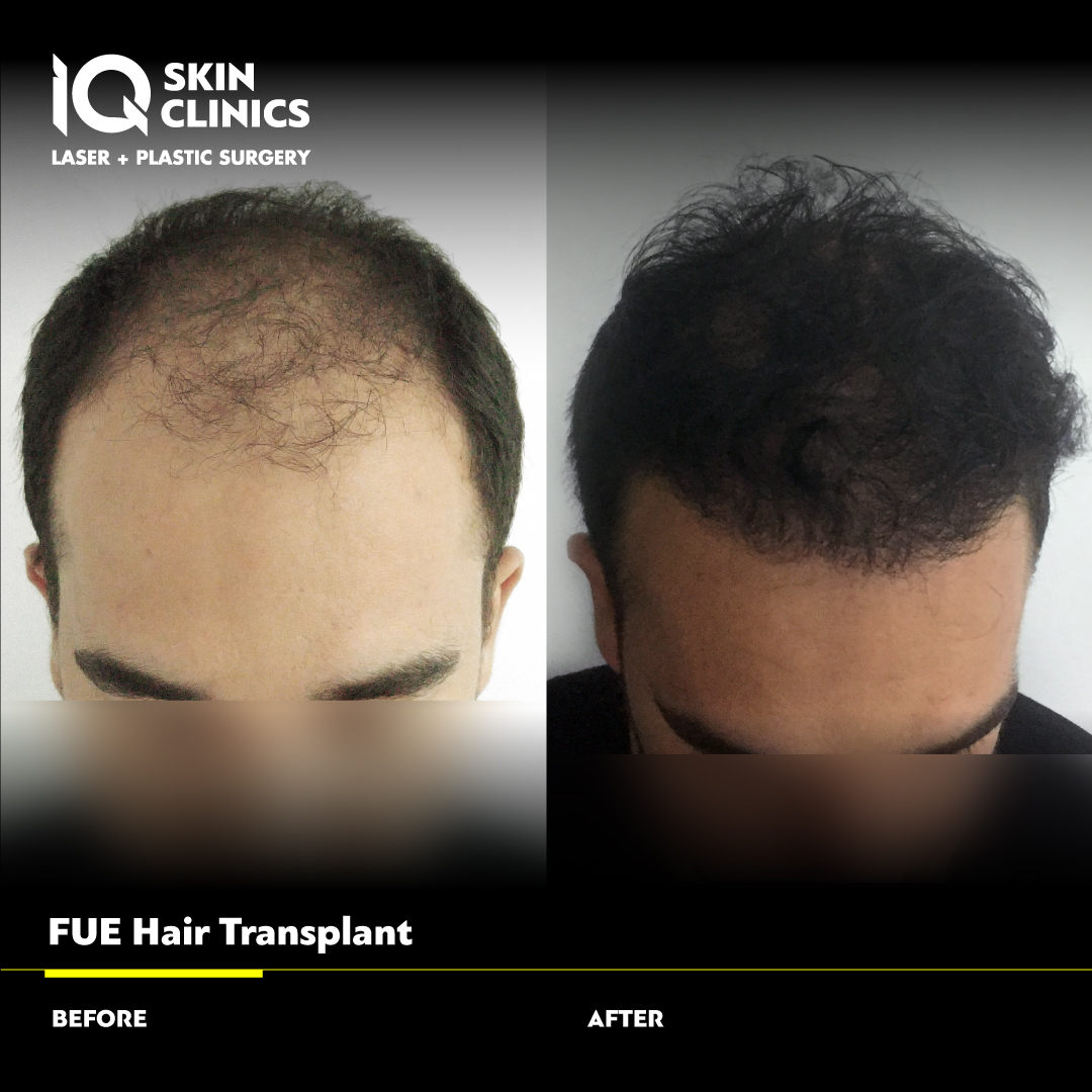 before-after-iq-clinic