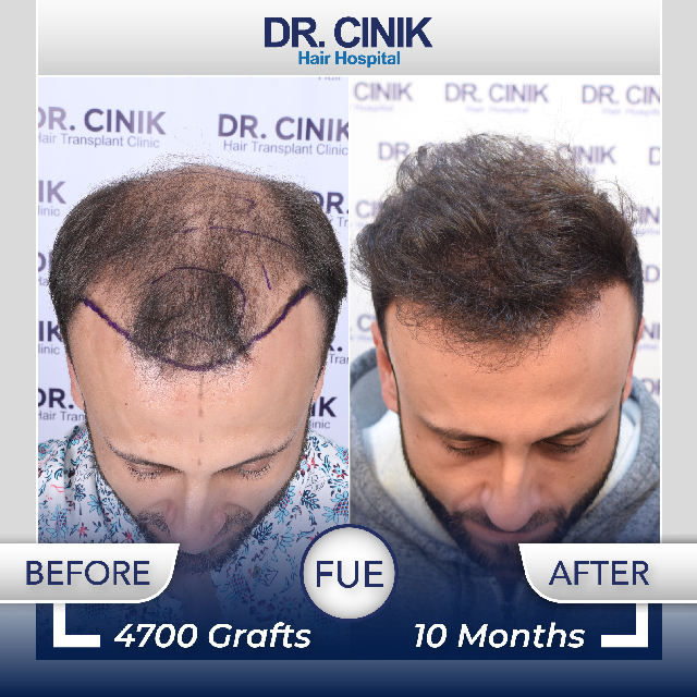 Dr-Cinik-Ιstanbul-before after