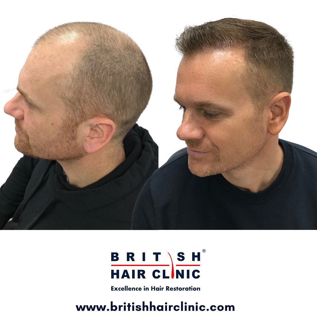 British-Hair-Clinics-Brentwood-result-1