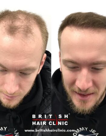 British Hair Clinics, Brentwood