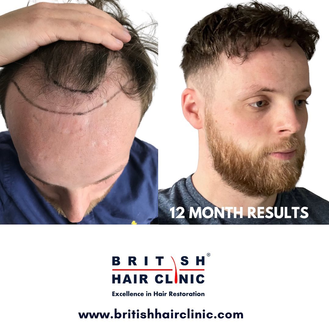 British-Hair-Clinics-Brentwood-result-5
