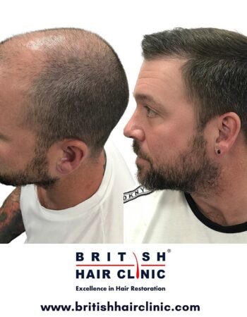 British Hair Clinics, Brentwood