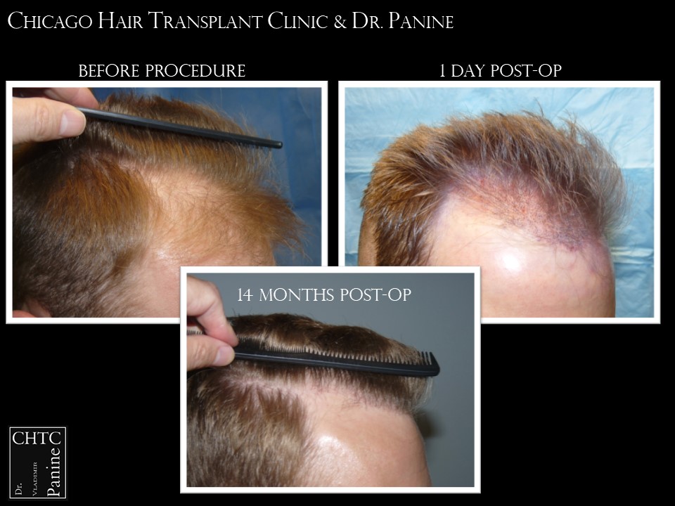 Chicago-Hair-Transplant-Clinic-result-3