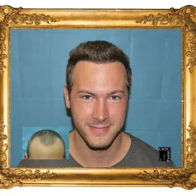 Chicago Hair Transplant Clinic, Chicago