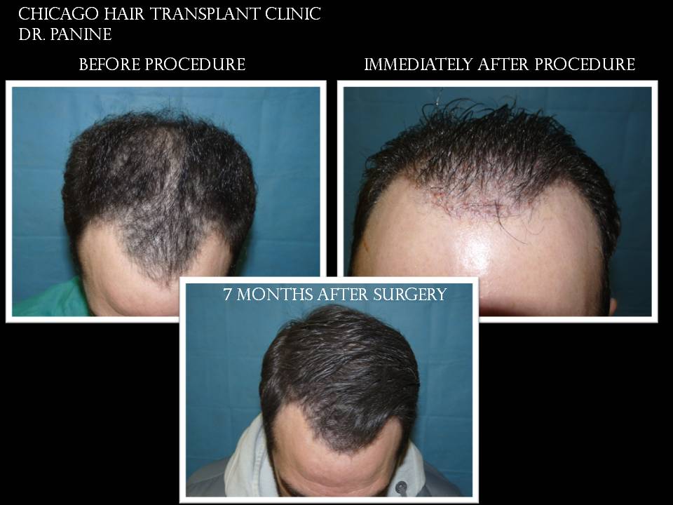 Chicago-Hair-Transplant-Clinic-result-5