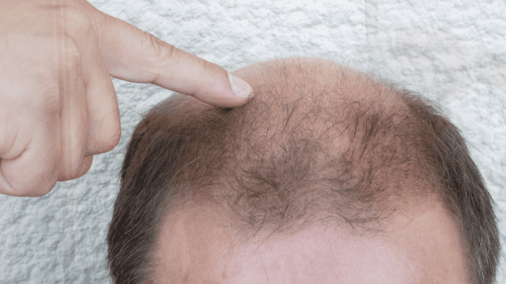 απώλεια-μαλλιών