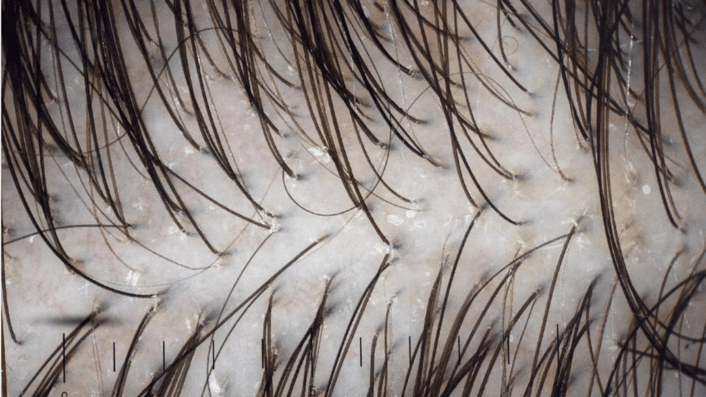 Advancements in Hair Cloning – Future Hair Loss Solutions